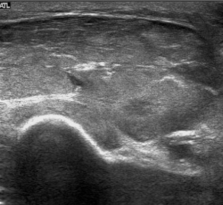 Figure 2 for case Diabetic myonecrosis with cellulitis